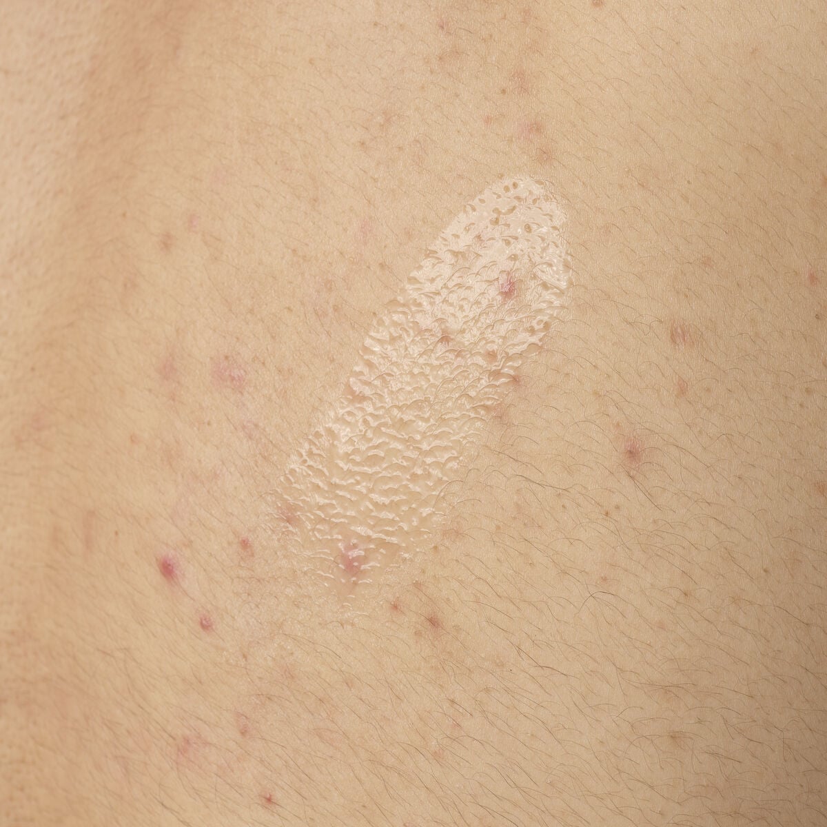 salicylic-acid-0-5-body-serum-b6 ORD-salicylic-acid-05-body-240ml-application.jpg