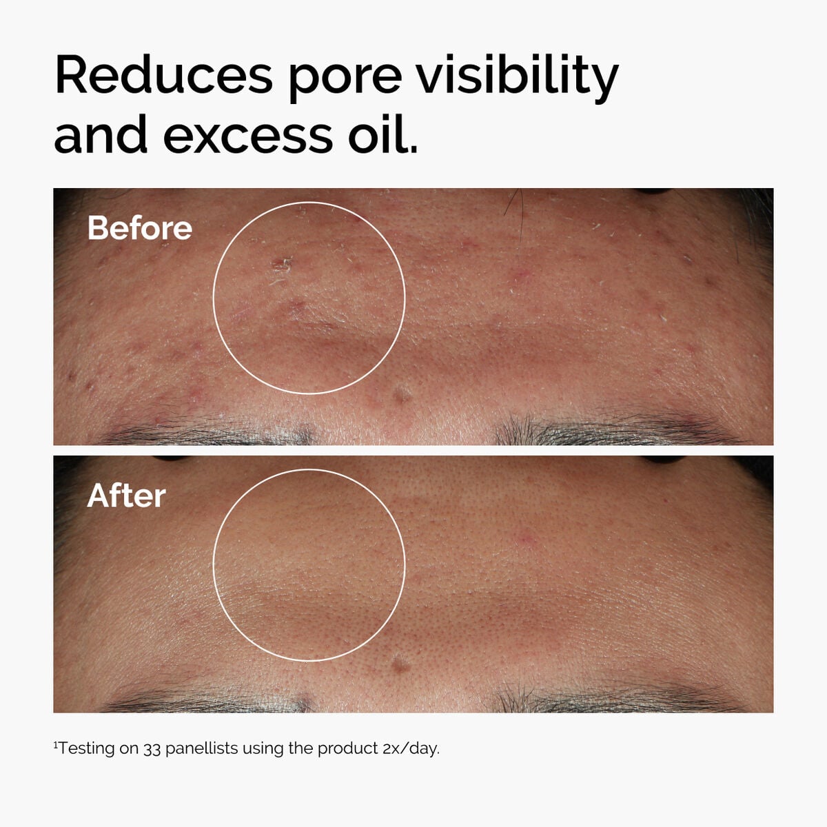 niacinamide-10-zinc-1-m2 ord-niacinamide-zinc-blemish-serum-before-after-pores.jpg