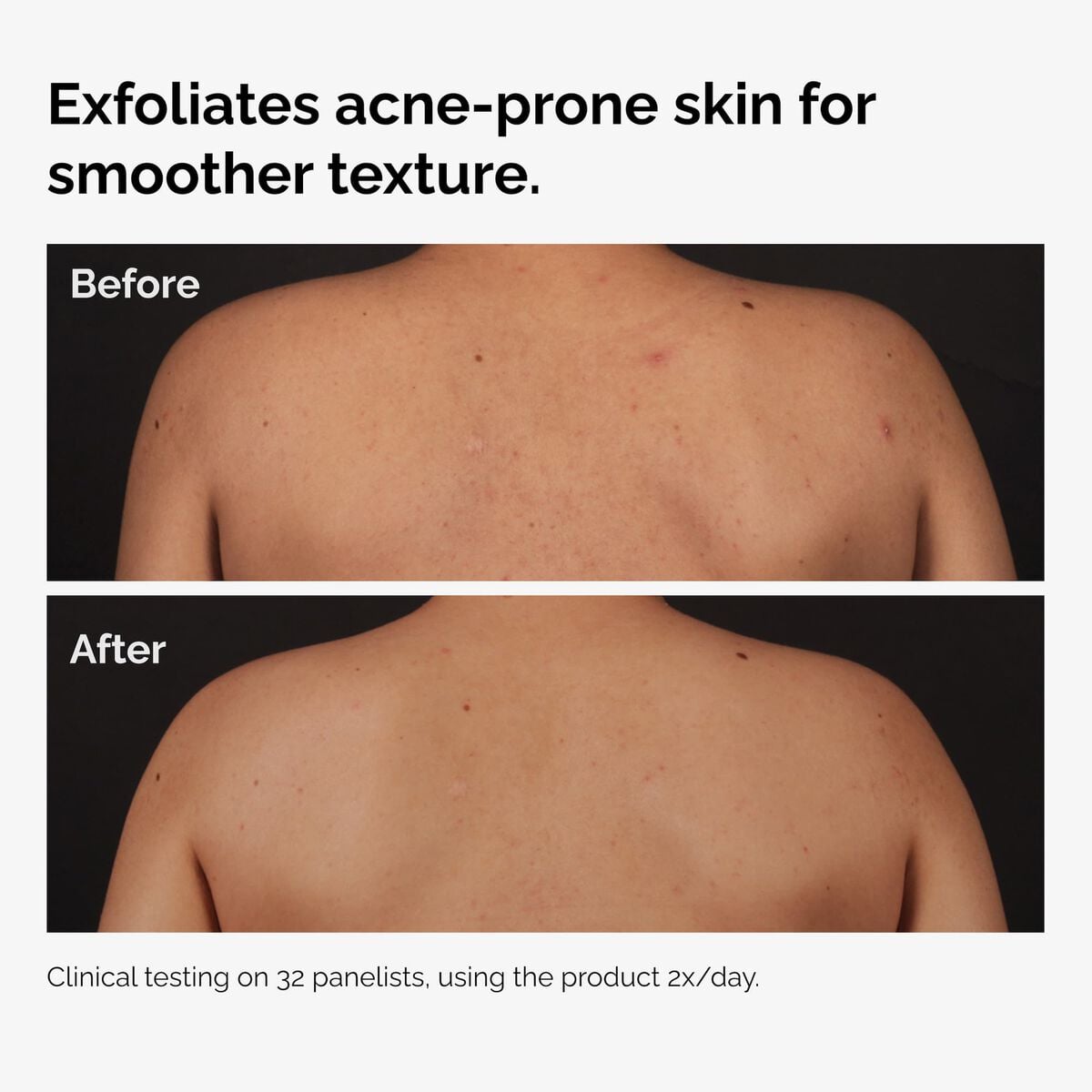 salicylic-acid-0-5-body-serum-b6 ord-salicylic-acid-body-serum-before-after-graphic-NA.jpg