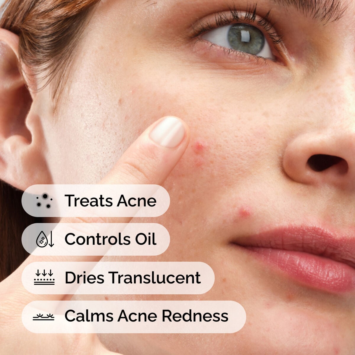 sulfur-10-powder-to-cream-concentrate-j7 ord-sulfur-10pct-powder-to-cream-concentrate-model-application-with-benefits-acne.jpg